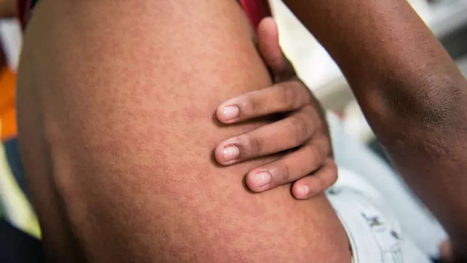 Sequelas da chikungunya podem afetar 3,7 mil em MS